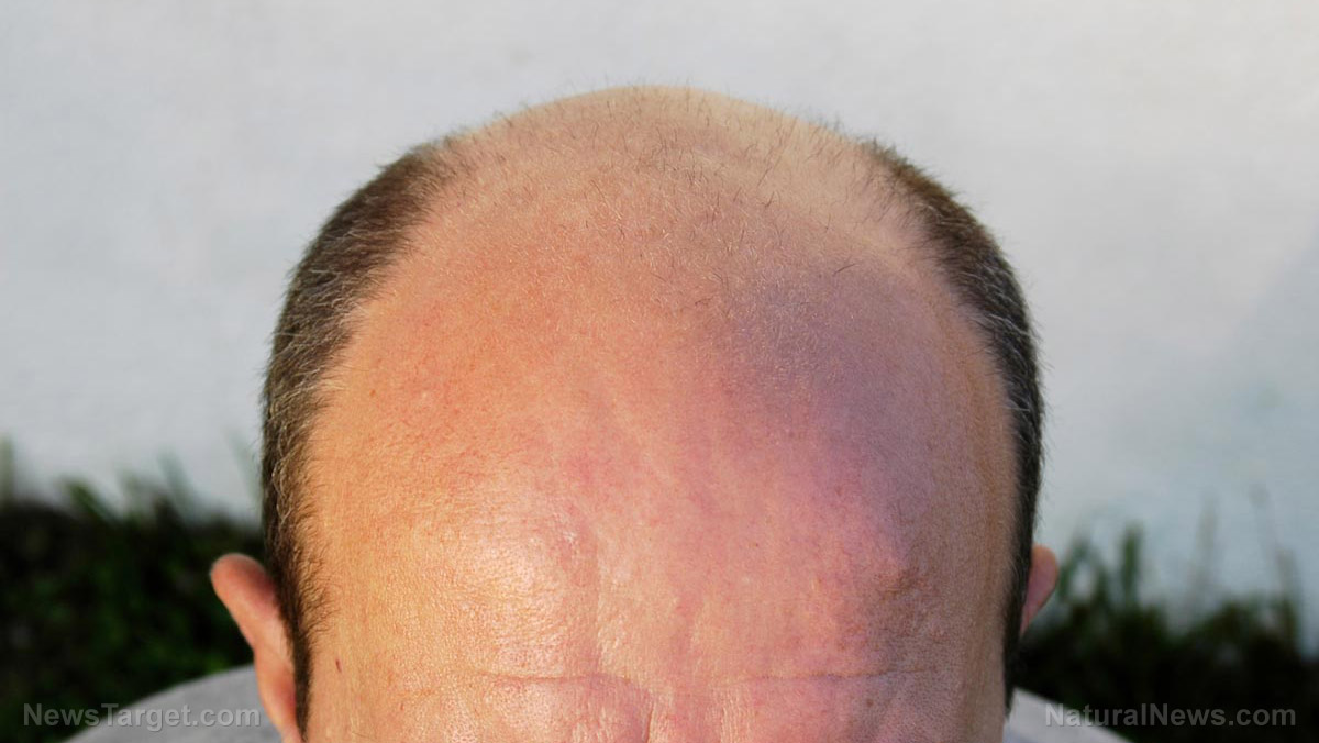 Study: Eating foods high in iron and protein helps prevent hair loss in men
