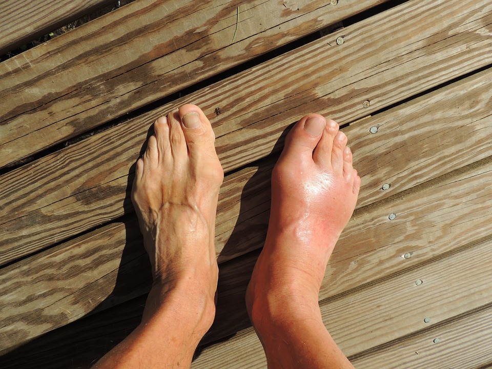 From midnight agony to lasting relief: Ancient strategies confront a modern gout epidemic